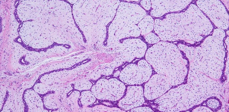 乳腺エコーの女 第8話 リクエスト編 『線維腺腫』~姉さん事件です!線維腺腫って奥が深いんですって! Peatix