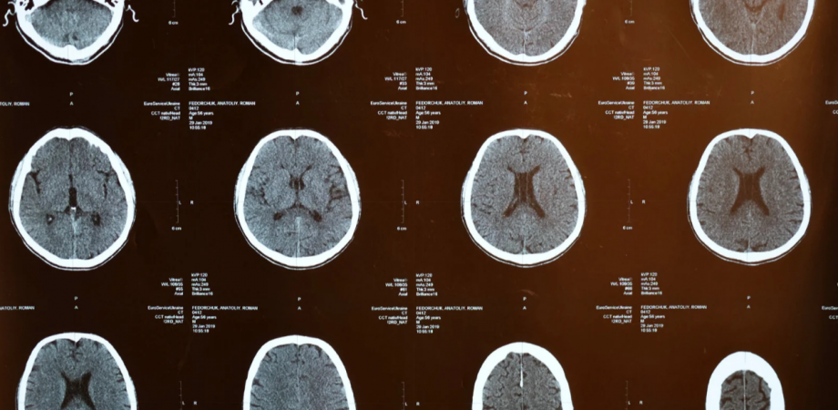 脳科学的視点から学ぶ高次脳機能障害｜無視症候群編（半側空間無視など）