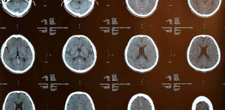 作業療法士のための脳科学的視点から学ぶ高次脳機能障害リハビリテーション｜無視症候群編（半側空間無視など）